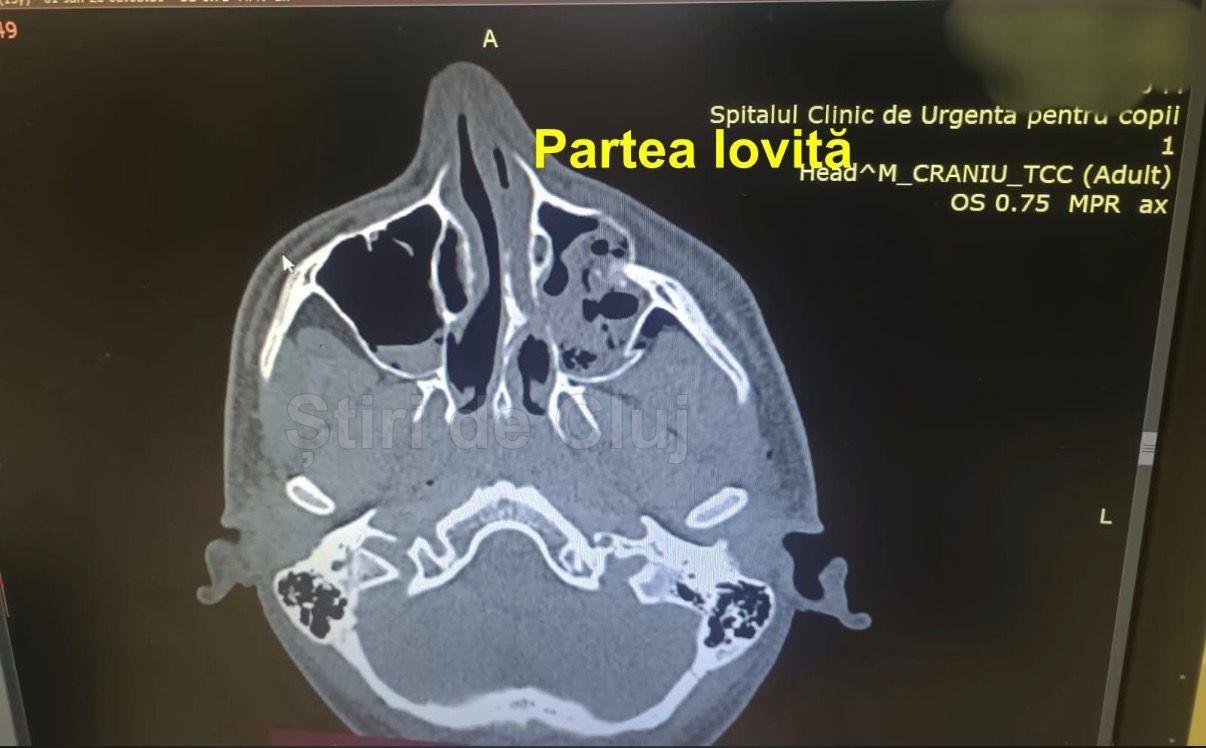 baiat batut cluj radiografie stiridecluj 2.jpeg