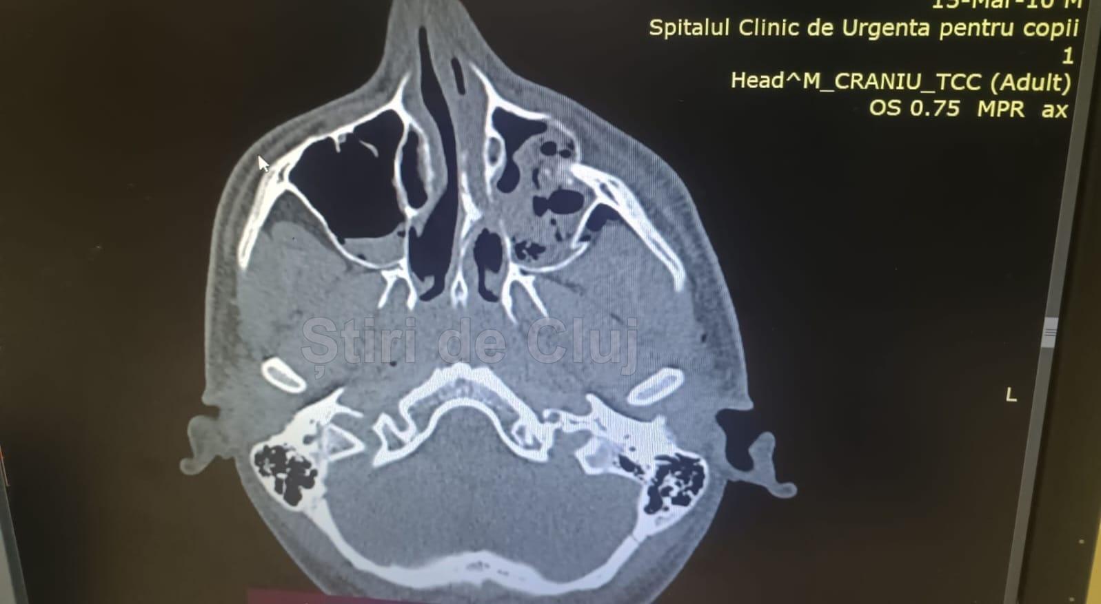 radiografie copil trimisa de mama pt stiri de cluj.jpeg