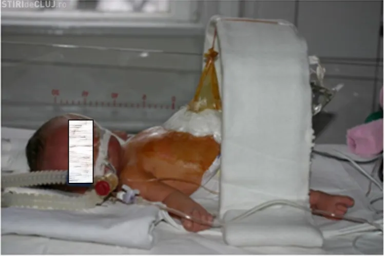 Chirurgul Ciuce a făcut la Cluj operații REVOLUȚIONARE pe copii - VEZI un astfel de caz - FOTO