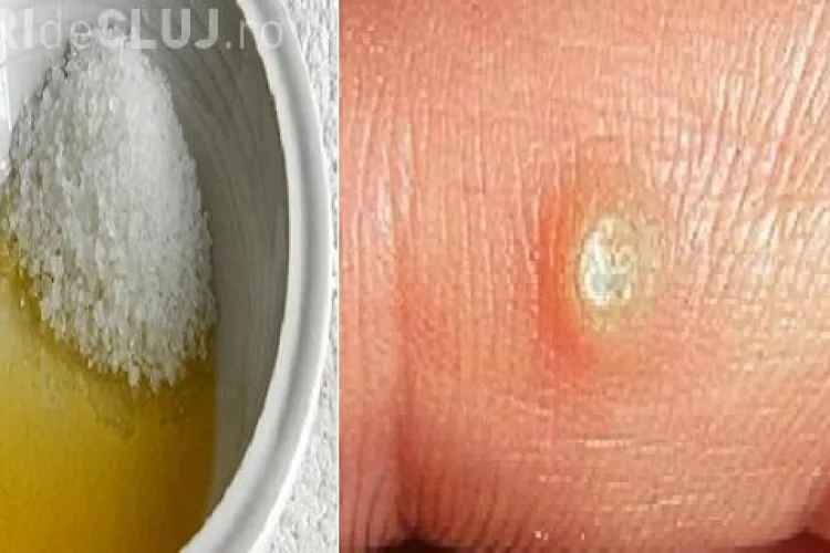 Scapi de negi în mod natural. Remedii și tratamente