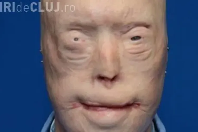 Medicina face minuni. I-a ars fața într-un incendiu, dar cum arată acum, după un transplant de față