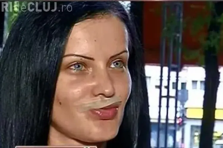 Unui manechin operat în România i-a explodat jumătate de buză. Reconstrucția costă o avere