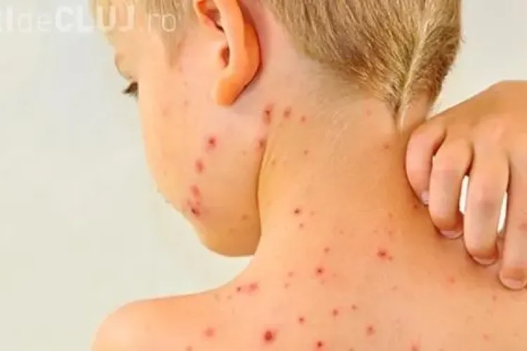Epidemia de rujeolă a pornit de la comunităţile de romi dintre Bistriţa și Cluj, unde copiii nu au fost vaccinați