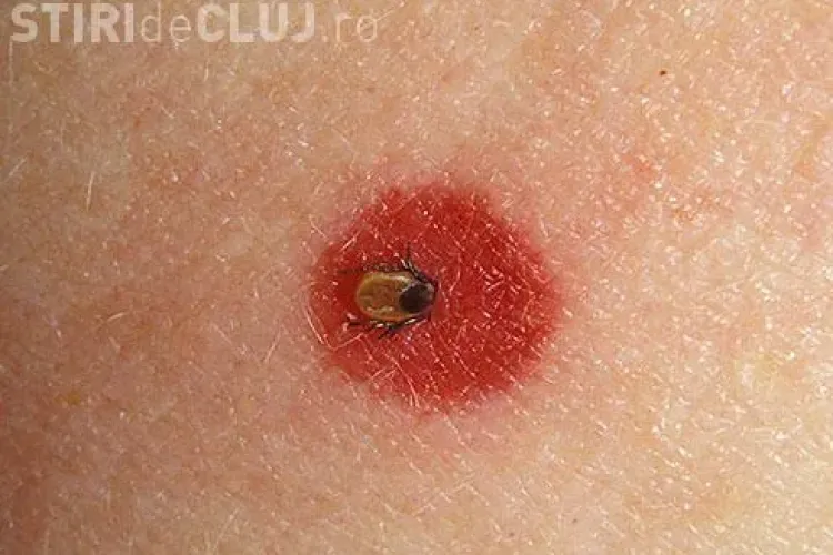 Medici: Leac pentru boala Lyme   