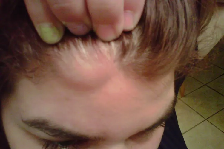 Care este cel mai rapid tratament naturist pentru lipoame