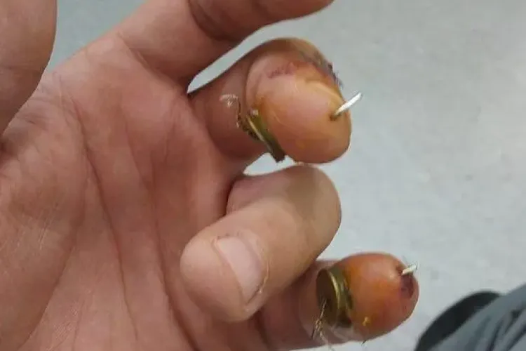 Cluj: Caz ȘOCANT la Spitalul de Recuperare din Cluj. Chirurgul Alexandru Georgescu i-a operat degetul greșit, fără să își dea seama