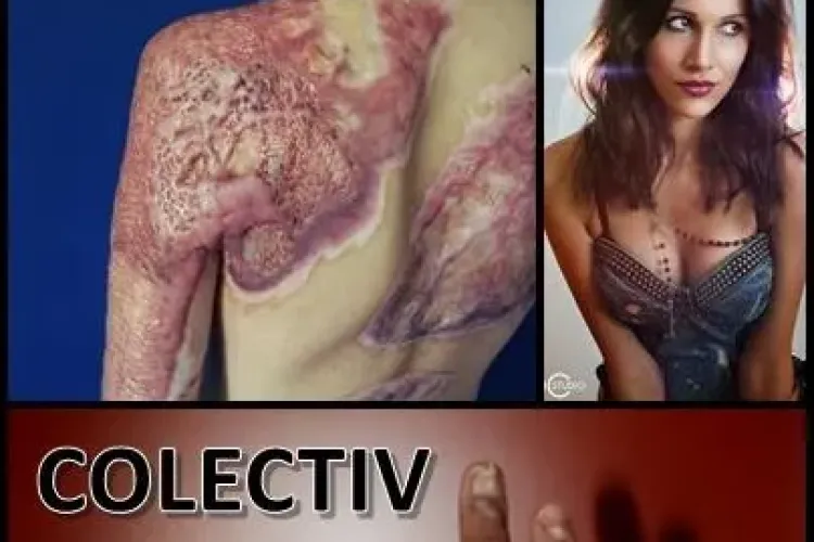 #Colectiv | Alexandra Furnea a povestit CALVARUL prin care a trecut 