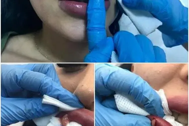 Unei clujence i-au explodat buzele, după un tratament de mărire - FOTO