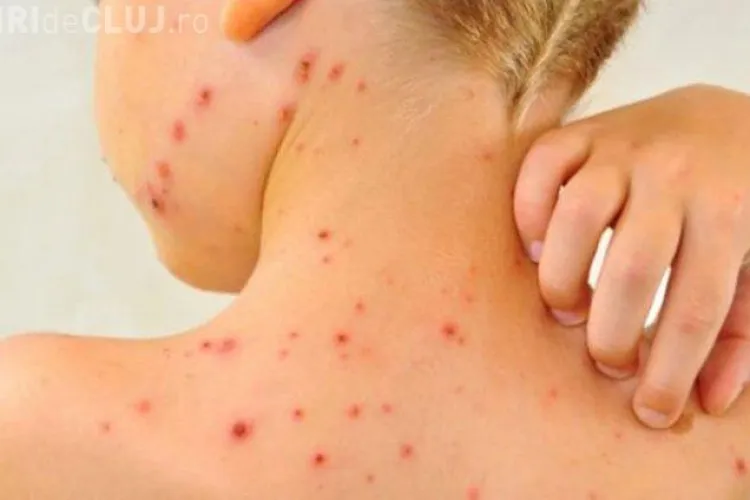 Rujeola tratată cu leacuri băbești