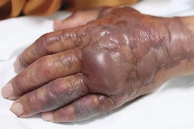 Un bărbat de 71 de ani s-a ales cu mâna amputată după ce a mâncat sushi 