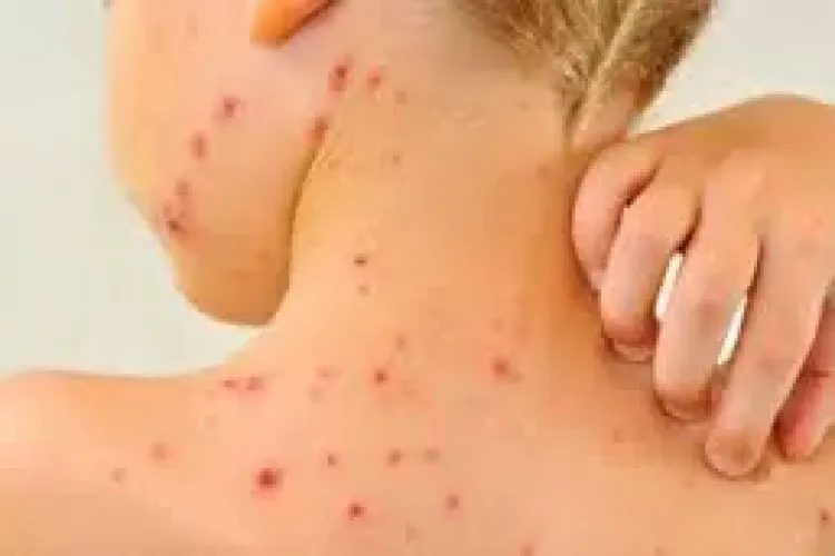 Peste 10 cazuri de rujeolă la Cluj, în doar câteva zile