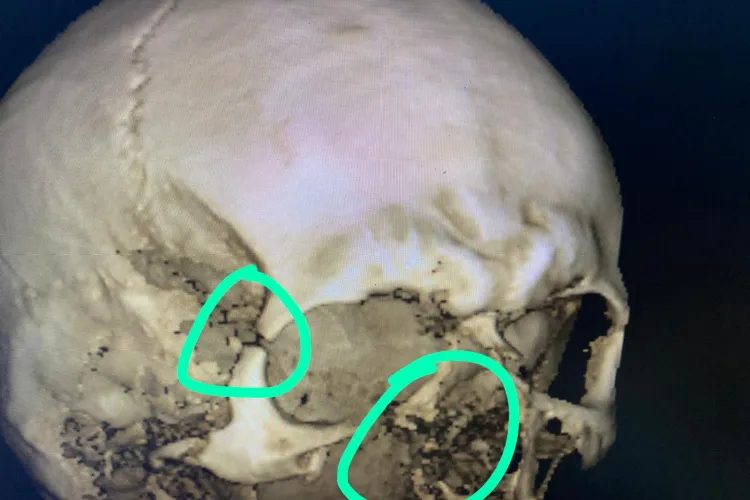 Polițist clujean cu ”pile” a desfigurat cu rozeta un schior la Mărișel. Agentul Marius Claudiu Rus e bine protejat și umblă LIBER