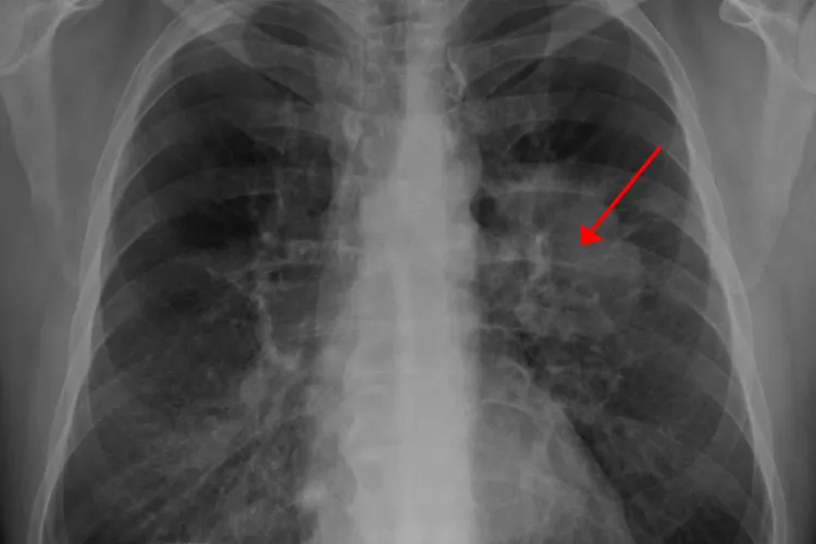 Coronavirusul nu lasă leziuni la nivelul plămânilor