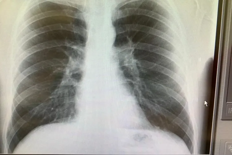 Cercetătorii au indicii care explică de ce unii oameni fac forme grave de COVID și alții nu