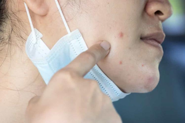 Cum să evitați apariția acneei provocate de purtarea măștii de protecție