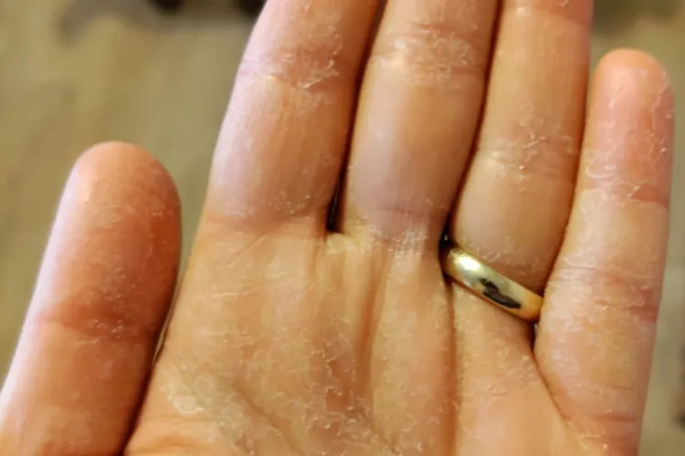 Cluj: Așa arată mâna unui medic de la ATI Cluj, secție COVID. Care este explicația imaginii - FOTO