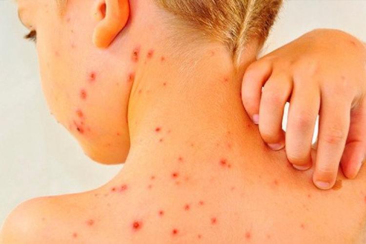 Se înmulţesc cazurile de varicelă la copii. Ce medicament e interzis să-l administrați celor mici 