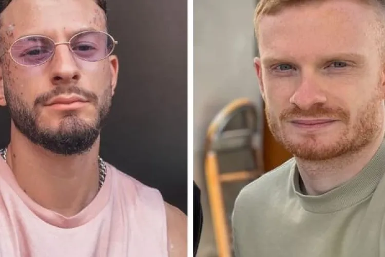 Prin ce calvar au trecut doi tineri infectaţi cu variola maimuţei: „Nu am avut niciodată astfel de dureri. Nu mai puteam să dorm sau să mănânc”