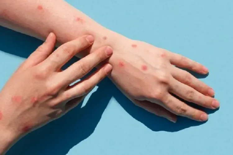 Un nou caz de variola maimuței, depistat în România. Numărul de îmbolnăviri a ajuns la 16