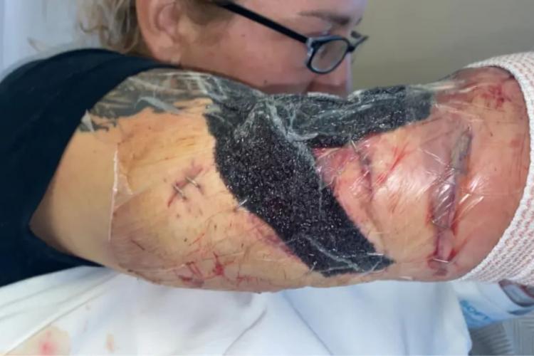 Femeie atacată de propriul câine, i-a smuls jumătate de braț: „A încercat să mă mănânce de vie”