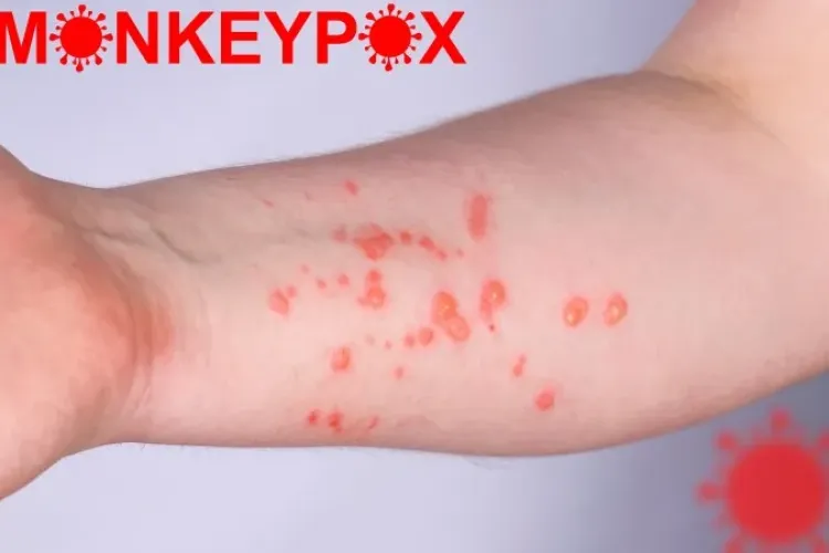 OMS convoacă comitetul de urgență: Este necesară determinarea măsurilor ce trebuie luate împotriva epidemiei de variola maimuţei