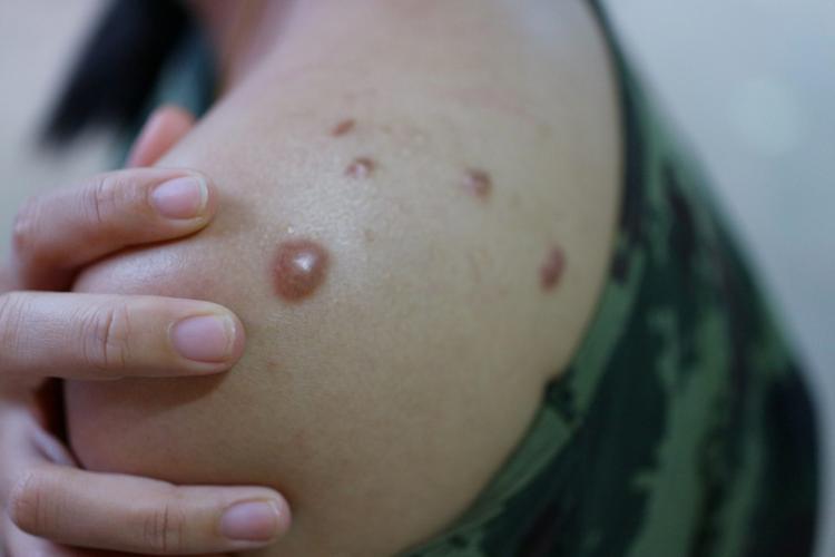 Două cazuri noi de variola maimuţei, confirmate în România. Numărul cazurilor din țara noastră a ajuns la 18 