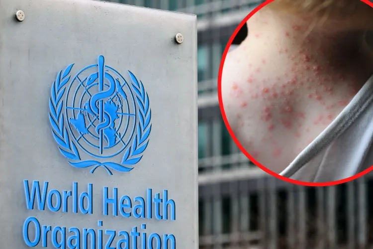 OMS cere în continuare sprijin pentru a redenumi variola maimuței. TRUMP-22 sau Poxy McPoxface, în topul ideilor trăsnite 