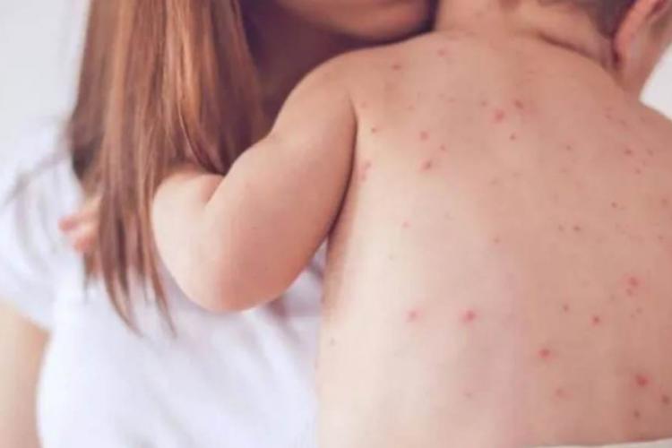 OMS: Rujeola, o amenințare globală iminentă. Milioane de copii au ratat vaccinul împotriva bolii