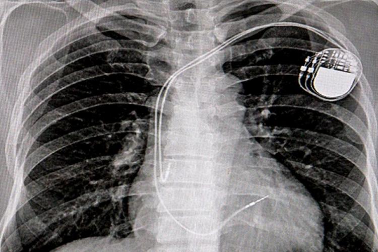 Doctorul Tesloianu a implantat dispozitive cardiace unor pacienți care nu aveau nevoie de o astfel de intervenție 