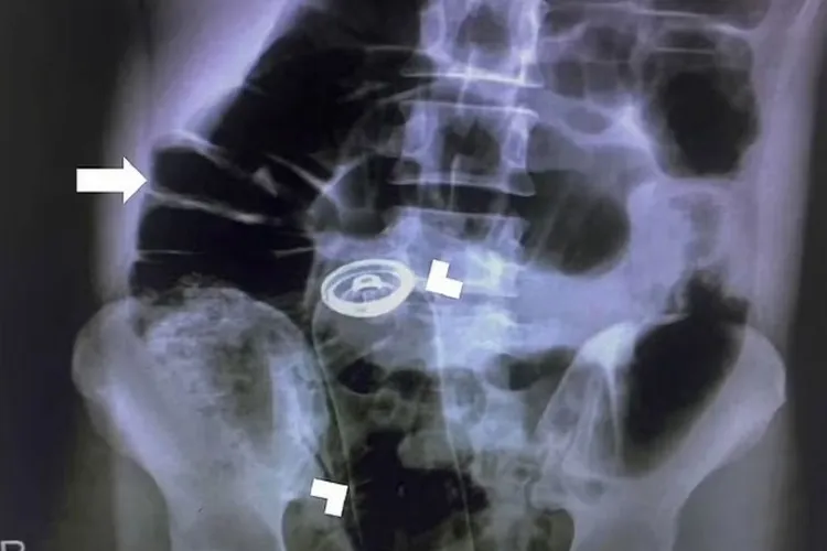 Un pacient s-a prezentat la spital cu un spray în organism, iar medicii l-au operat de urgență - FOTO