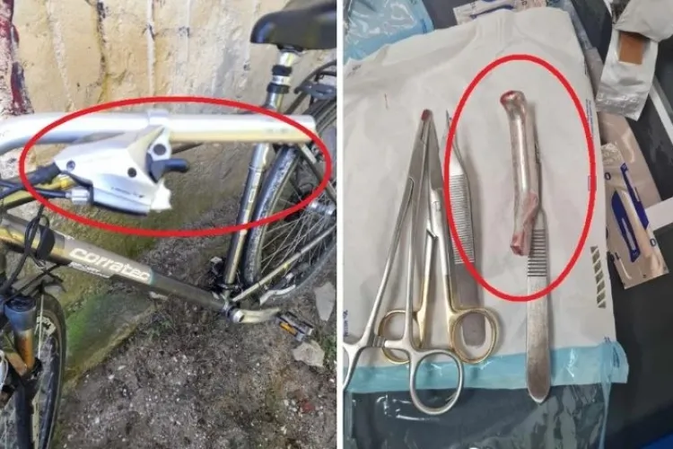 Un medic român a cusut în piciorul unui pacient mânerul de frână de la bicicletă 