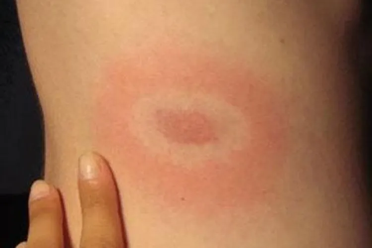 Clujul, in topul judetelor la cazurile de boala Lyme, afectiune transmisa prin muscatura de capuse