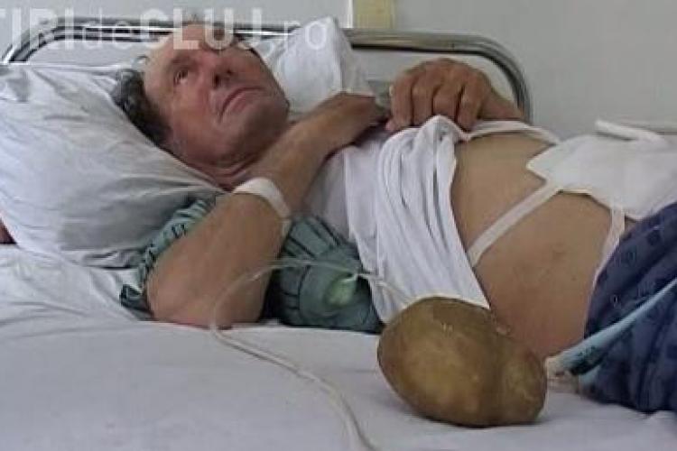 Un barbat avea o piatra la rinichi de un kilogram VIDEO