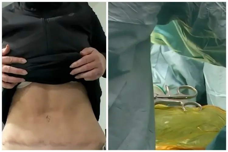Chirurg estetician din Cluj, acuzații grave de la o pacientă în suferință: „Am avut 5 luni abdomenul deschis și nu pot respira”/A plătit mii de euro VIDEO
