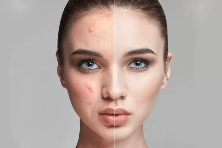 Cea mai bună veste pentru adolescenți și tineri: Apare vaccinul anti acnee. Când este estimat că va fi disponibil pe piață
