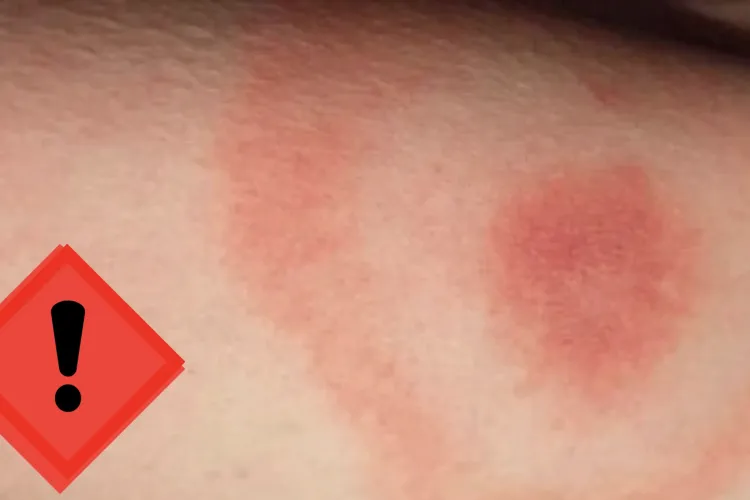 Insecte misterioase atacă persoane într-un parc din Cluj: Mușcăturile provoacă umflături și teamă printre vizitatori!