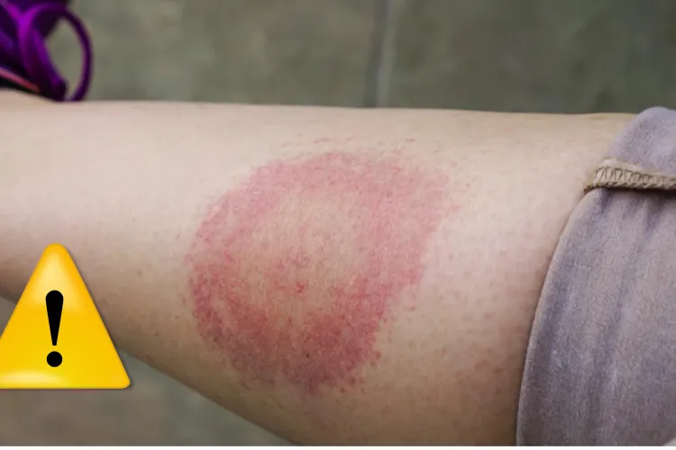 Clujul sub asediul insectelor misterioase? Noi înțepături bizare în Gheorgheni: „E groaznic, nu am mai văzut așa ceva!”