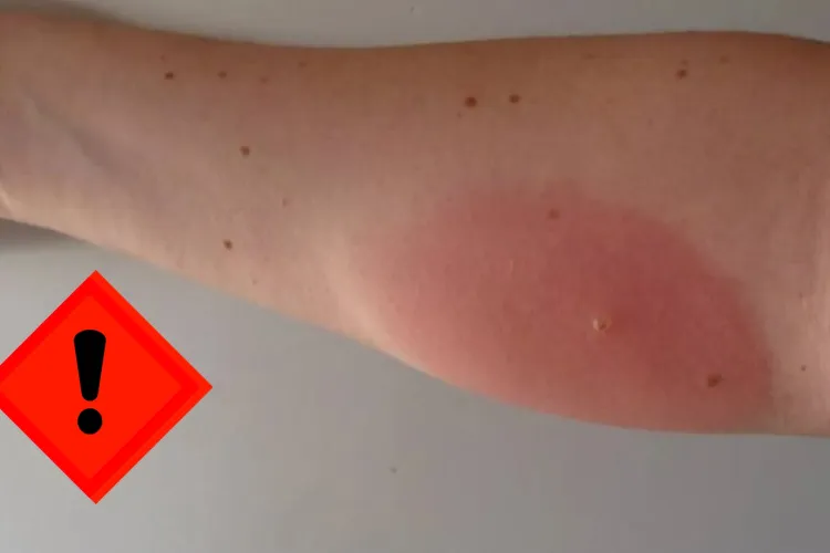 Alertă în Cluj: Insecte necunoscute mușcă oameni în zona Mărăști! Victimele: „E groaznic, nu știm ce sunt!”