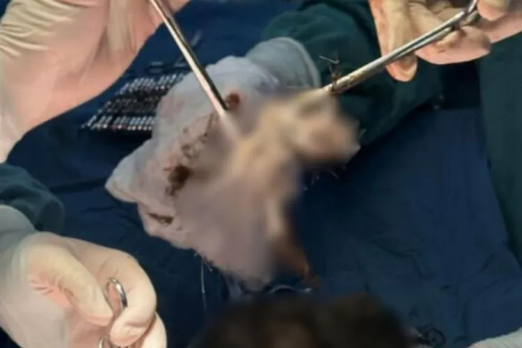 O tânără de 15 ani, salvată în ultimul moment: Medicii i-au scos din stomac o „minge de păr” de 2 kilograme, formată în 6 ani de dependență bizară