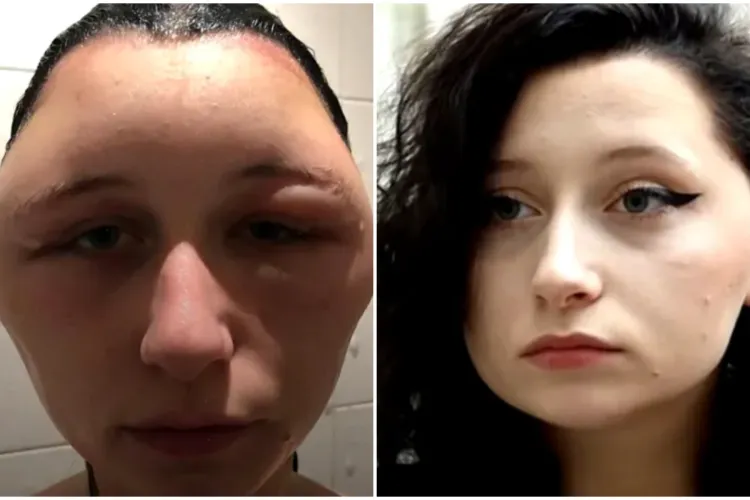 O tânără a fost aproape de moarte după ce a decis să-și vopsească părul acasă. „Fruntea îmi devenise de două ori mai mare”
