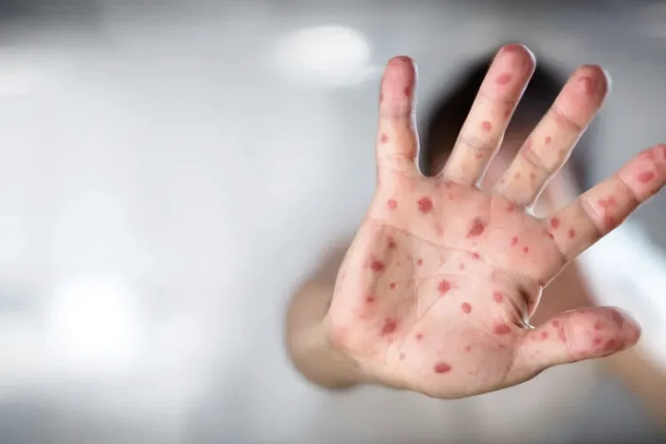 Alarmă medicală la Cluj! 52 de cazuri de rujeolă într-o singură lună, cel mai mare număr din țară – INSP avertizează asupra riscurilor majore