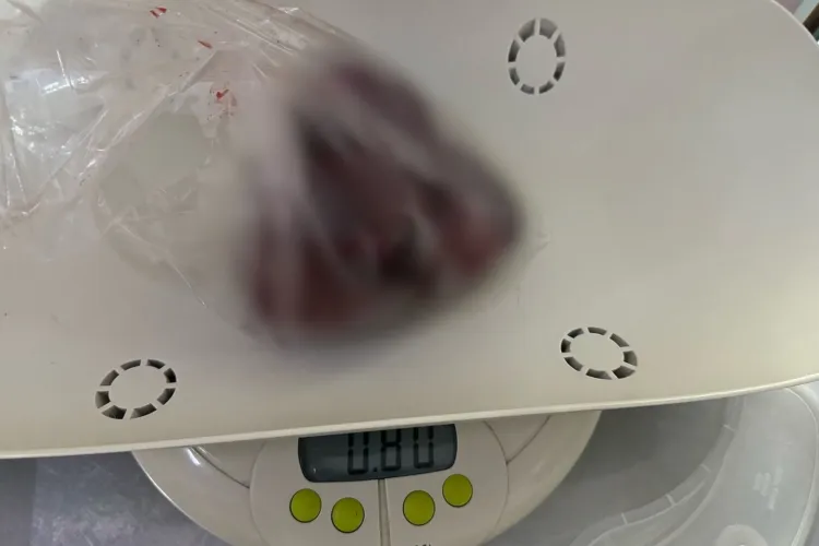 Operație extrem de complexă, dusă la bun-sfârșit în Cluj-Napoca: Unui nou născut i s-a înlăturat o tumoră gigant de 800 de grame FOTO