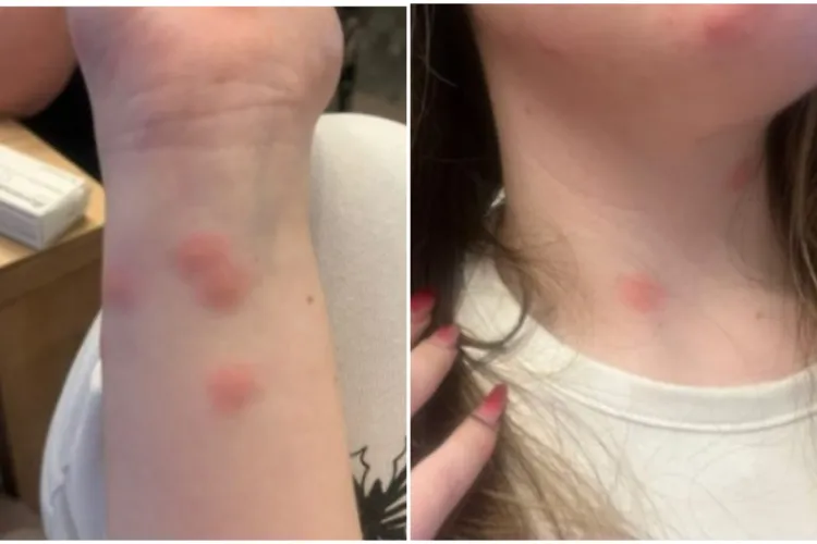 O tânără a ajuns la spital după ce a fost mușcată de ploșnițe într-un tren CFR. Familia a depus plângere. Cât a costat-o „experiența”