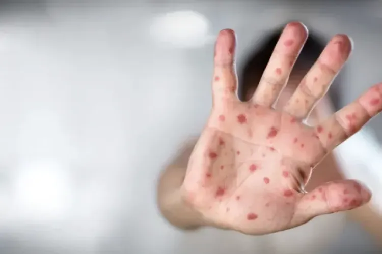 Epidemia de rujeolă se extinde! Peste 35.000 de cazuri și 30 de decese. Medicii trag un semnal de alarmă