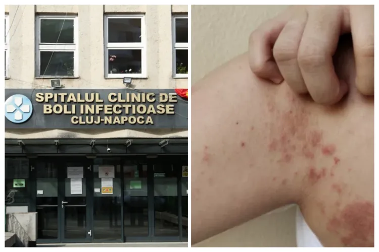 Anchetă extinsă în cazurile de lepră de la Cluj. Alte patru persoane au fost evaluate: „Nu prezintă semne ale infecției” 