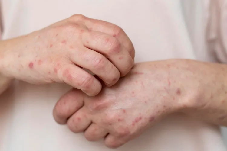 OFICIAL: Încă un caz probabil de lepră la Cluj, după cel confirmat ieri. Două tinere din Asia, maseuze la un salon, au fost internate. Alte 2 suspecte