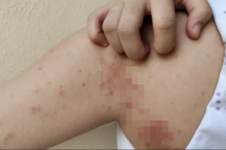 Un caz de lepră confirmat la Cluj. Încă trei suspecte. Toate cele 4 sunt maseuze asiatice la un salon de spa din Cluj. Ultimul caz, acum 44 de ani!