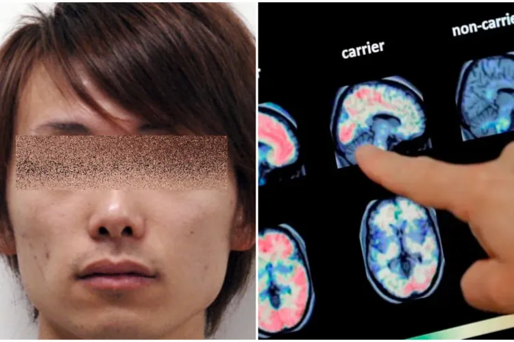 Cel mai tânăr pacient cu Alzheimer din lume are doar 19 ani. Medicii sunt șocați, însă cred că totul are legătură cu consumul ridicat de zahăr