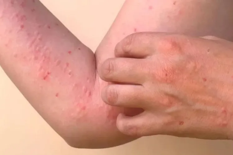 Ce este virusul Chikungunya, depistat pentru prima oară în România? Boala provine din Africa și a fost adusă la noi de un turist