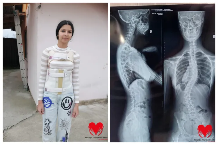 Erika are doar 15 ani și are nevoie de urgent de ajutorul vostru: „Fiecare zi îmi curbează coloana. Vreau să pot să merg la școală. Operația e șansa mea”